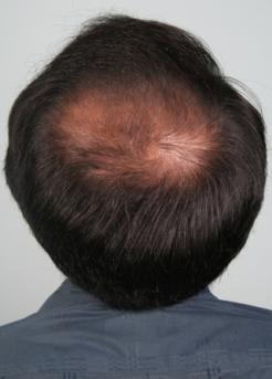Before Hair Transplant&nbsp;Midscalp